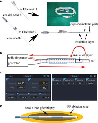 A Novel Biopsy Method Based on Bipolar Radiofrequency Biopsy Needles